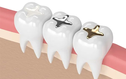 Dental Amalgam Fillings Treatment