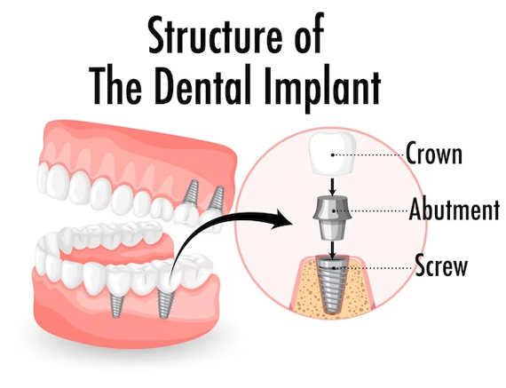Same Day Dental Implants