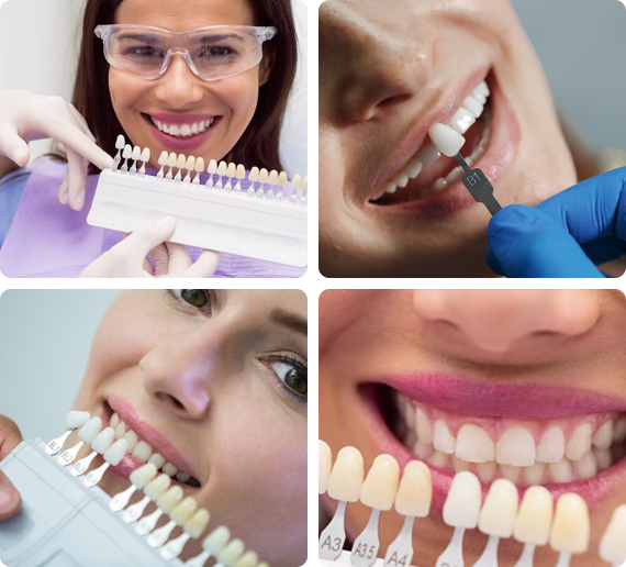 Custom Veneer Treatment