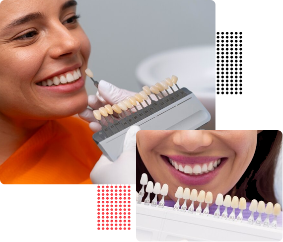 Benefits of Dental Veneers