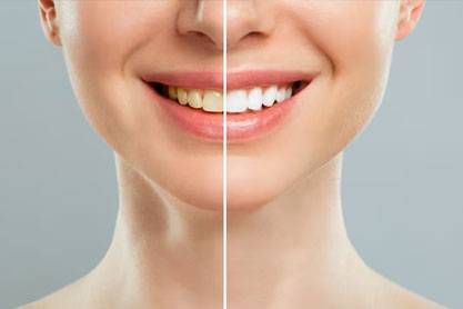 Teeth Whitening