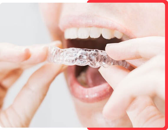 Maintaining Invisalign Braces