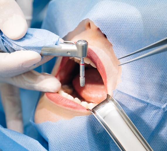 Painless Root Canal Treatment