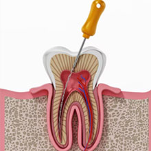 Root Canal Treatment