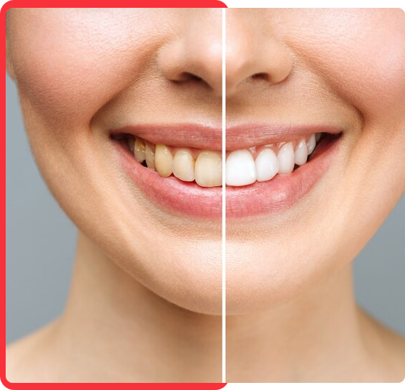 Dental Whitening Service