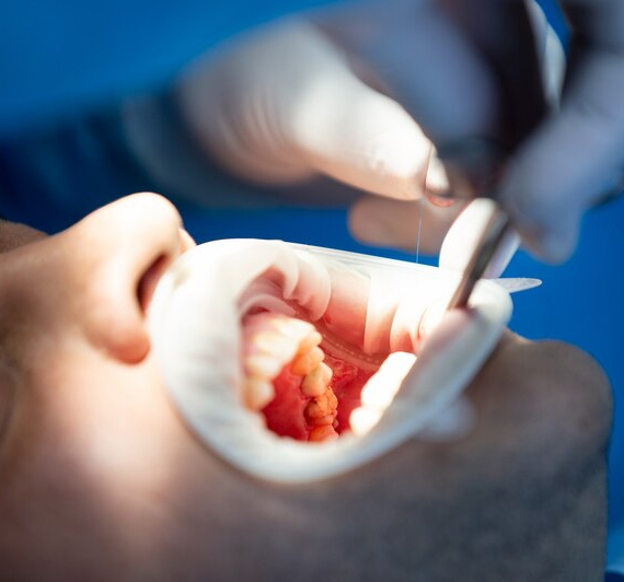 Replacing Extracted Teeth