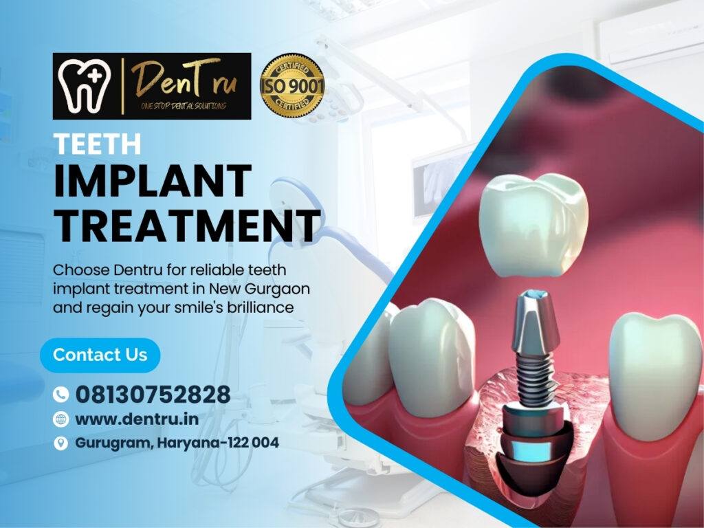 Get Rid of Gaps with Best Dental Implants in Gurgaon