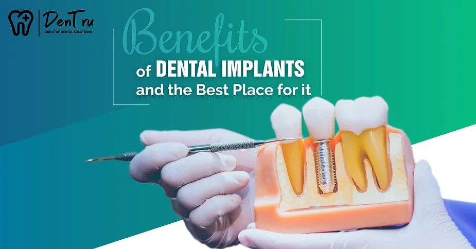 Benefits of Dental Implants and the Best Place for it