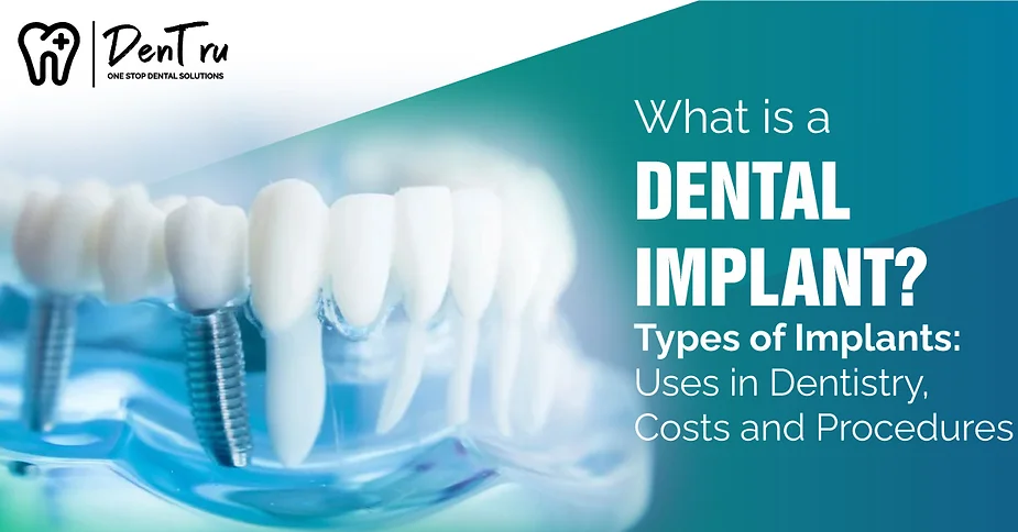 What is a dental implant?