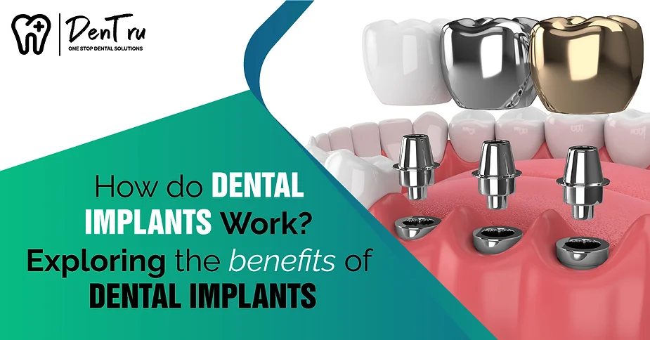 How do dental implants work?